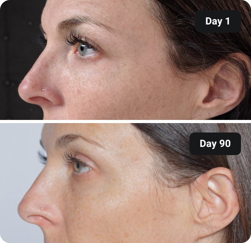 Collagen before and after results