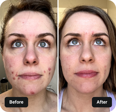 4 Week Gut Protocol before and after results